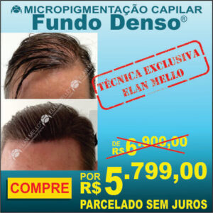 Micropigmentação Capilar "Fundo Denso®"