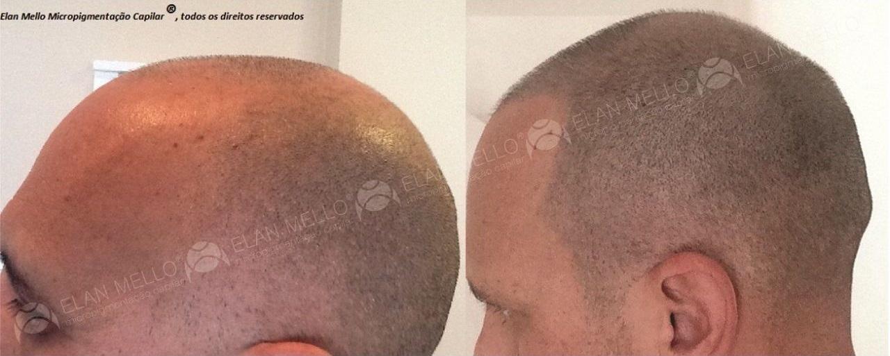 micropigmentação capilar cabelo rapado camuflar calvície
