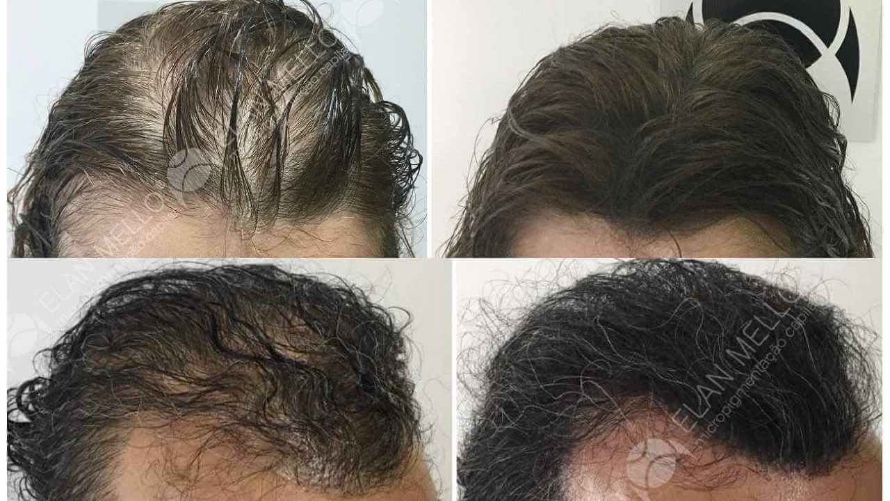 micropigmentação capilar Fundo Denso para homem mulher e transplante