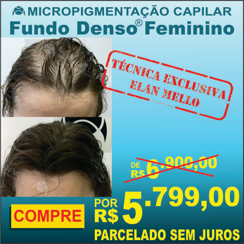Micropigmentação Capilar "Fundo Denso®" Feminino