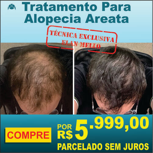 Tratamento para Alopecia Areata