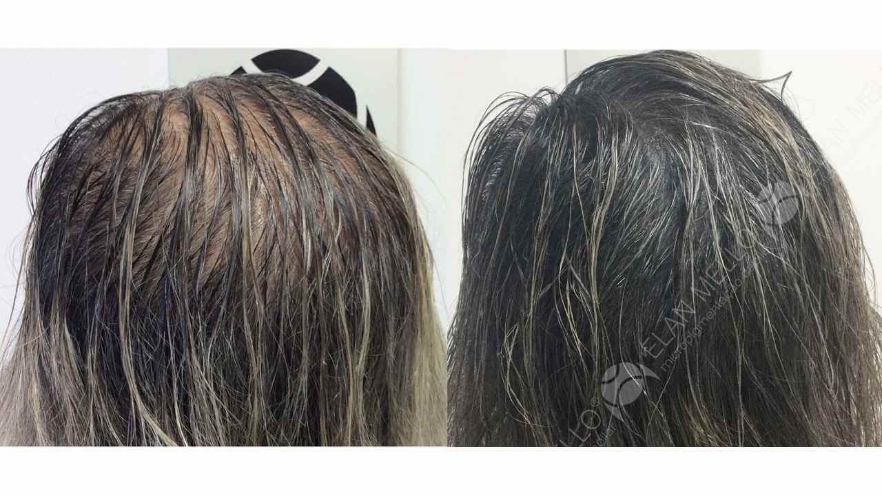 Micropigmentação Capilar "Fundo Denso®" Feminino - Imagem 4