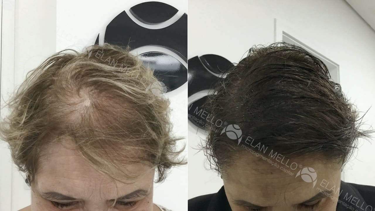 Micropigmentação Capilar "Fundo Denso®" Feminino - Imagem 8