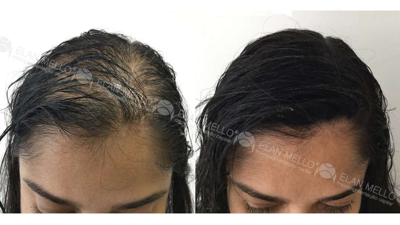 Micropigmentação Capilar "Fundo Denso®" Feminino - Imagem 2