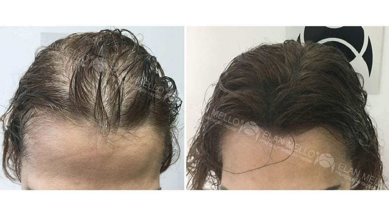 Micropigmentação Capilar "Fundo Denso®" Feminino - Imagem 10