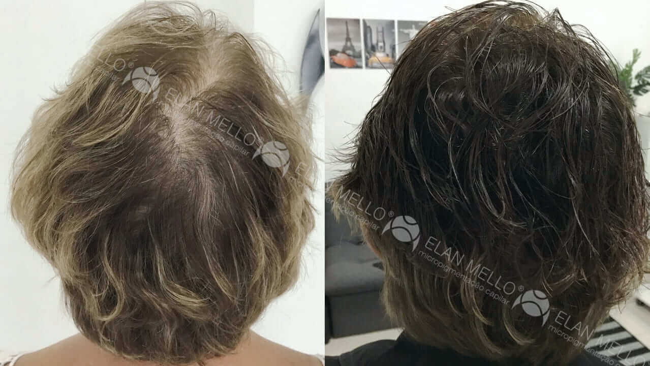 Micropigmentação Capilar "Fundo Denso®" Feminino - Imagem 9
